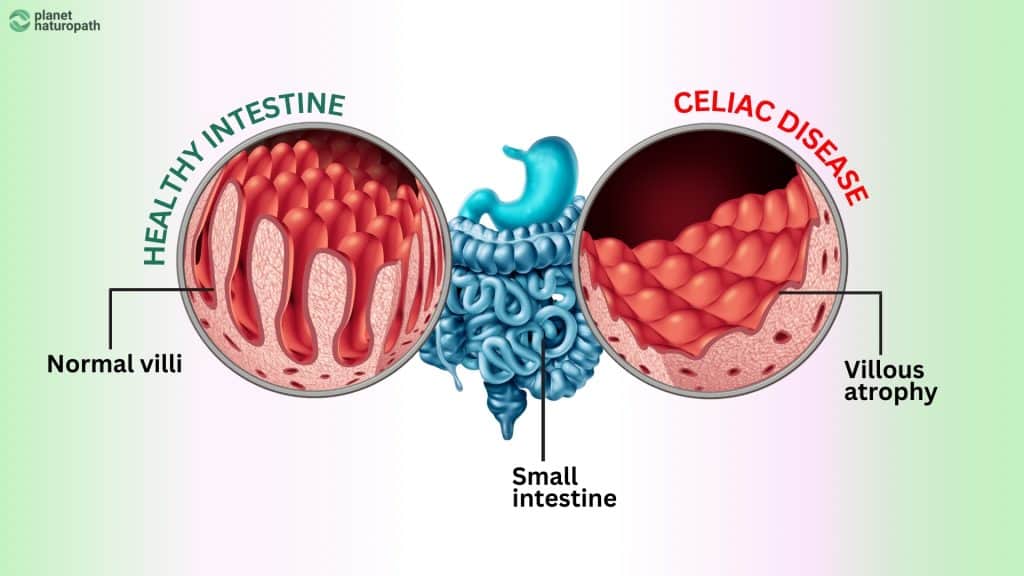 Celiac & Gluten Intolerance Gut Health