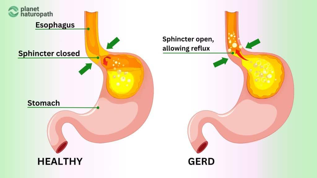 GERD Reflux infographic