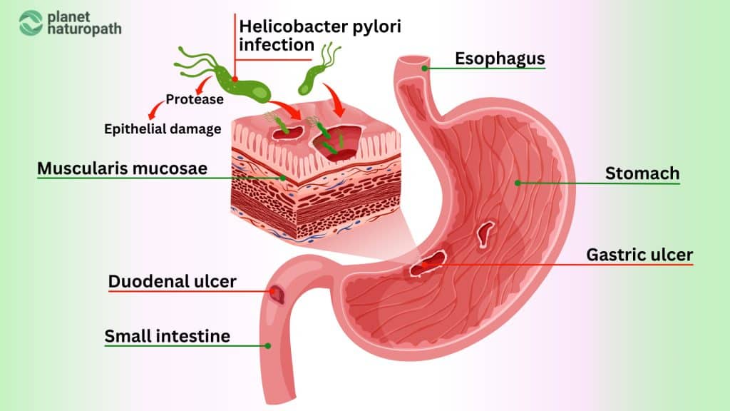 Helicobacter Pylori Infection infographic