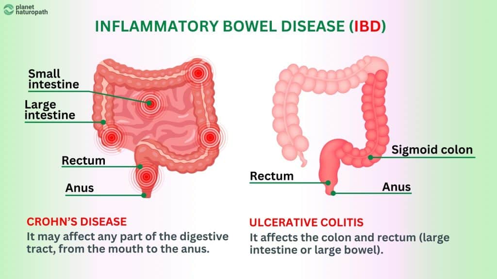 IBD Gut Health