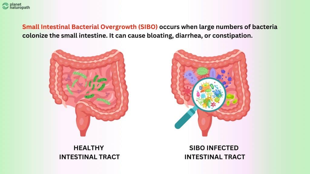 SIBO gut health