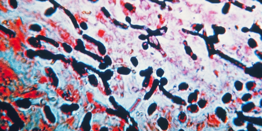 FibroScan Fatty Liver